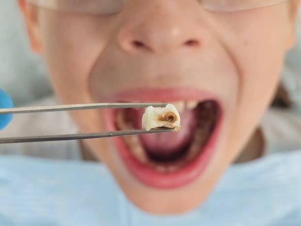 Best Emergency Tooth Extraction in Festus, MO